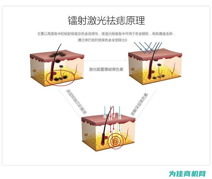 各类点痣仪器图片大全 (各类点痣仪器的区别)